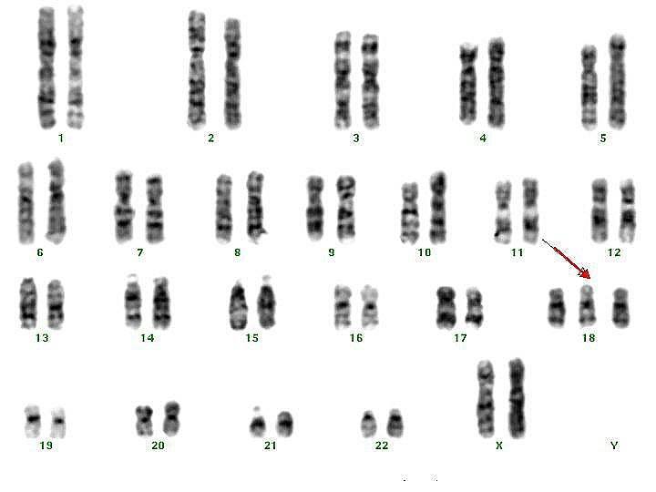 Появление в генотипе лишней хромосомы